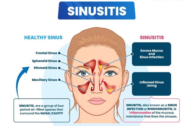 Sinusitis Causes Symptoms Sinus Infection Symptoms Causes And 