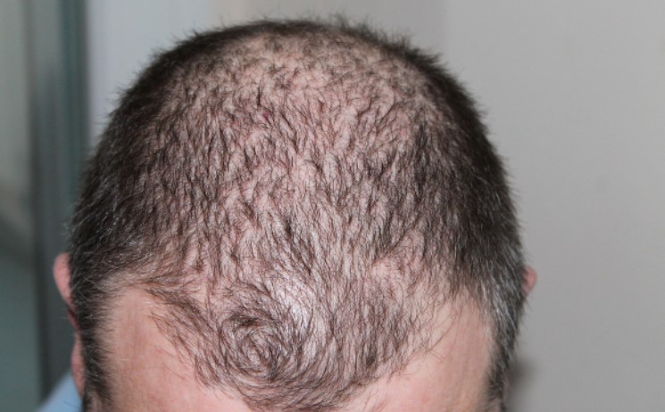 Platelet-rich plasma Therapy for Hair Loss  PRP therapy is a treatment for hair loss that uses the patient's own blood plasma, that is rich in platelets, to promote hair growth.