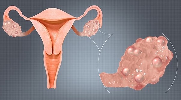 Polycystic Ovary Syndrome is a medical condition that affects women of reproductive age. PCOD problem lead to irregular periods, weight gain, and conceiving.