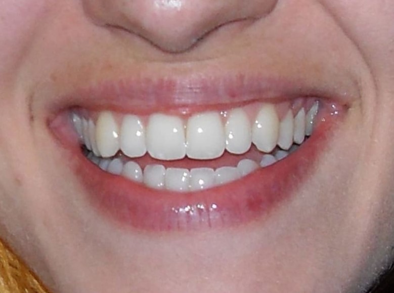 Teeth Gums and Anti-Scorbutic Vitamins.