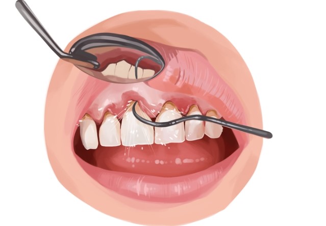 A diet centered on white flour, refined sugar, and vegetable fats was found to be detrimental to native peoples' health, teeth, and gums.