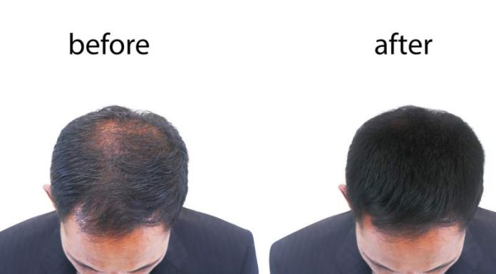 Reclaiming Your Confidence: How Hair Transplant Can Change Lives How Hair Transplant Can Change Lives Imagine waking up every morning with renewed confidence, ready to take on the day without worrying about hair loss.