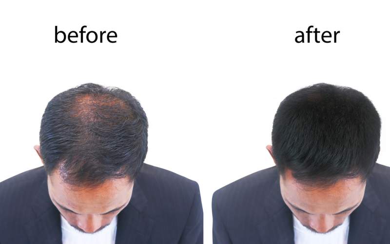How Hair Transplant Can Change Lives Imagine waking up every morning with renewed confidence, ready to take on the day without worrying about hair loss.